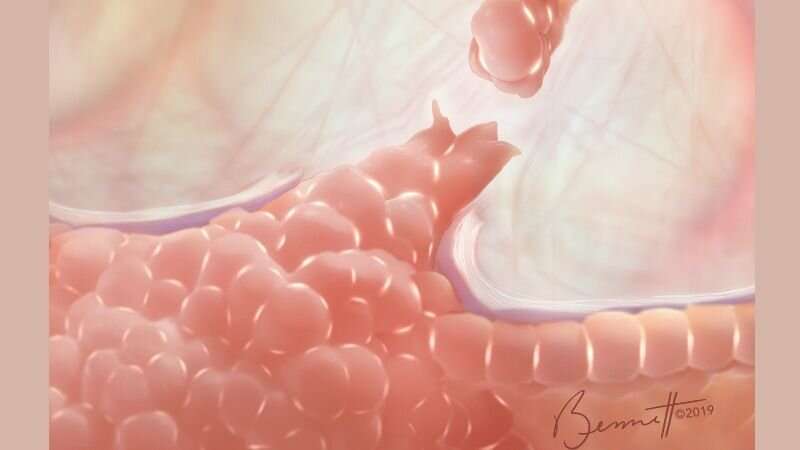 揭示乳腺癌转移关键调节因子,研究表明什么可以治疗乳腺癌