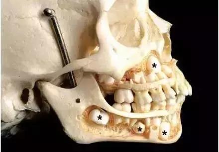 小黑点的蛀牙不严重吗,蛀牙了一点点黑色也得补么