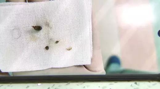 小女孩*体下**塞入异物流血不止！隔了几天走路都不对劲了