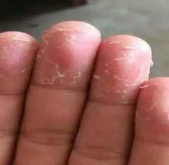 7岁孩子手指上换季脱皮,手指脱皮是身体求救信号