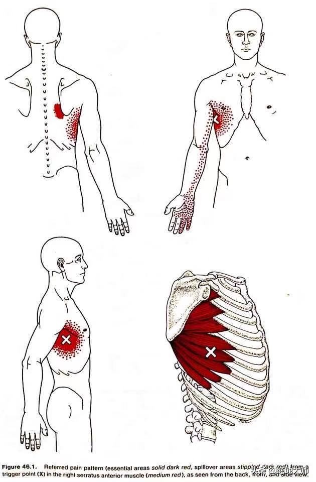 肩胛疼痛为何要做康复,肩胛区疼痛治疗