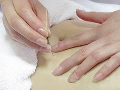 针刺不进去是怎么回事,针刺进针正确方法