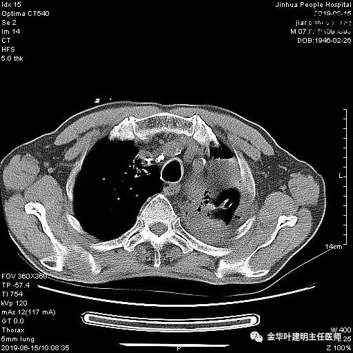 肺手术后乳糜胸是医疗事故吗,肺部切除后乳糜胸治好了