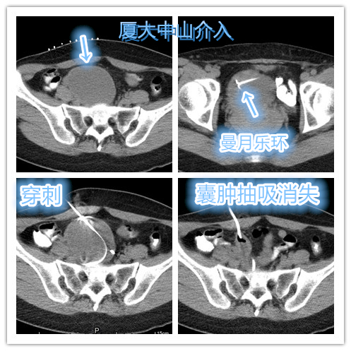 卵巢巧克力囊肿容易复发吗,卵巢巧克力囊肿容易恶化吗