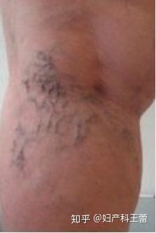 孕晚期36周后关注事项,孕晚期胎儿缺氧怎么关注