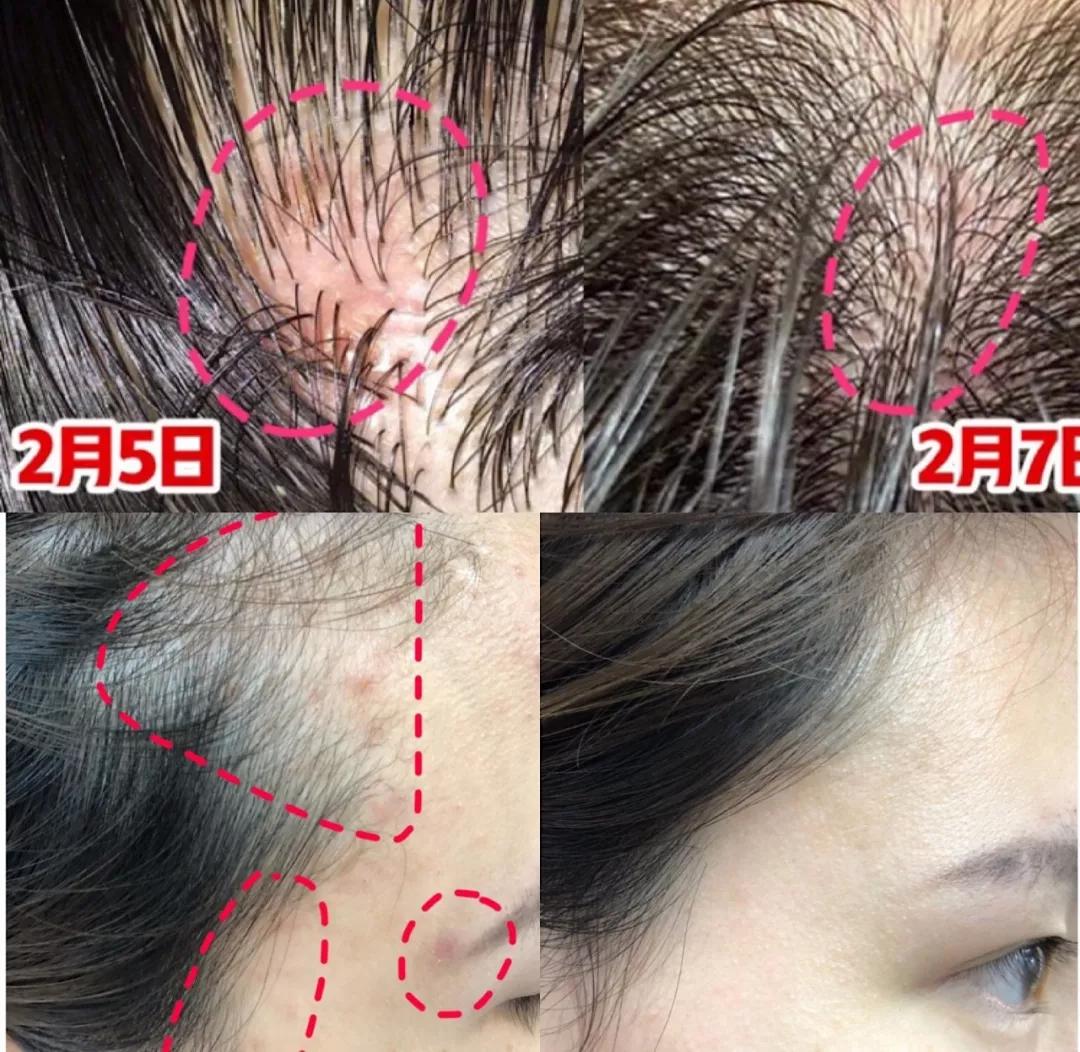 头发毛躁头屑多头皮痒怎么保养,头皮痒头屑多怎么根除