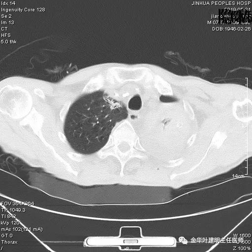 肺手术后乳糜胸是医疗事故吗,肺部切除后乳糜胸治好了
