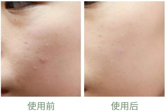 女生闭口粉刺怎么办,有闭口粉刺做什么医美