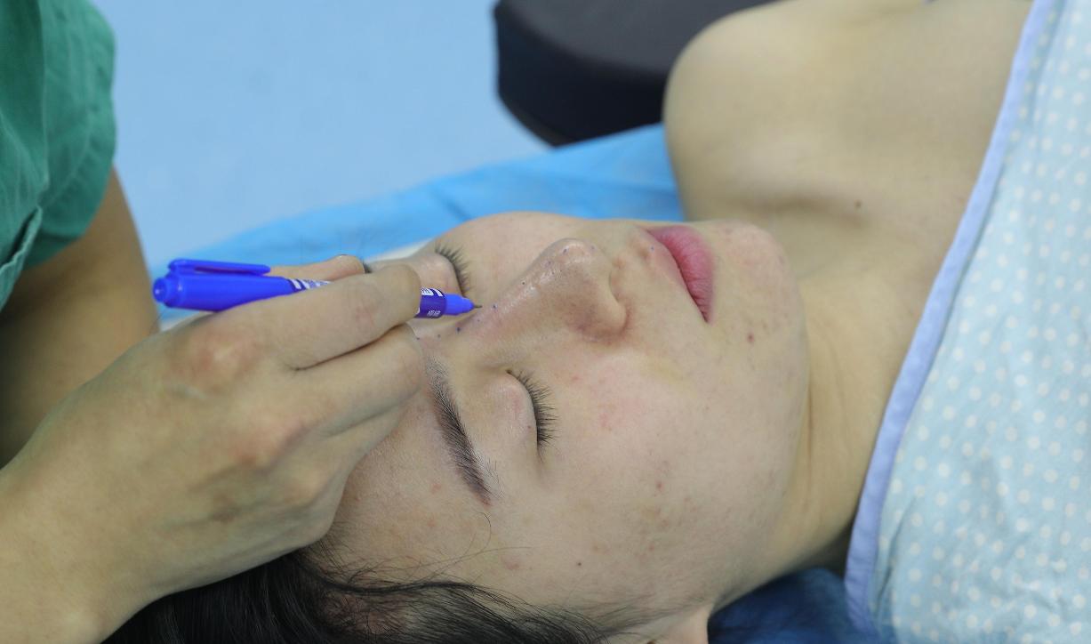 鼻子太塌改善的小窍门,鼻子太塌怎么办整形