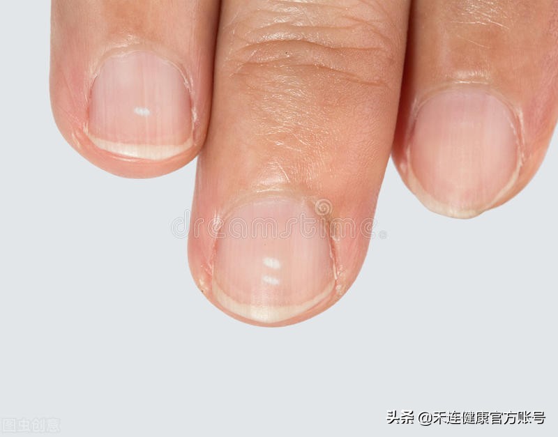 指甲上白色月牙很小正常吗,大拇指指甲有白色月牙怎么回事