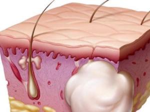 妇科炎症反反复复用什么能治好,妇科炎症反反复复怎么能彻底祛除