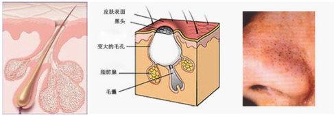 毛孔粗大黑头多怎么改善小技巧,毛孔粗大黑头多的原因和改善方法