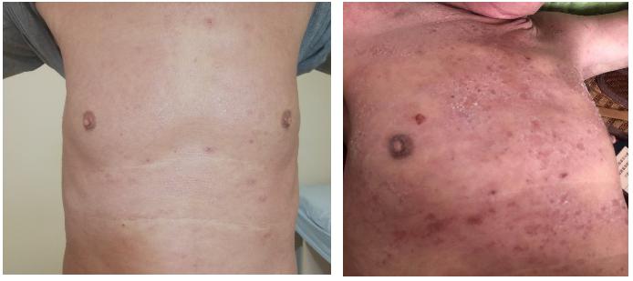 王孟昭看肺癌怎么样,王孟昭大细胞肺癌