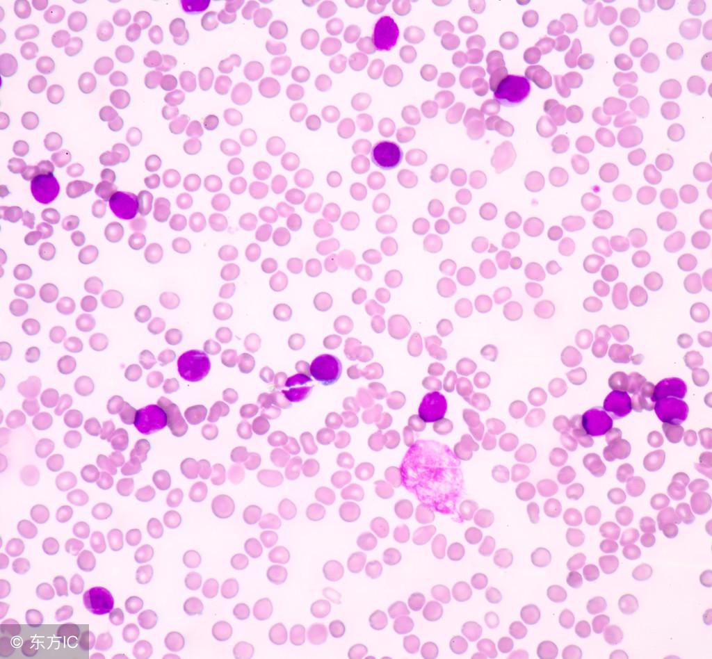 腋窝下的瘤是不是淋巴瘤,腋窝下有硬块就一定是淋巴结吗