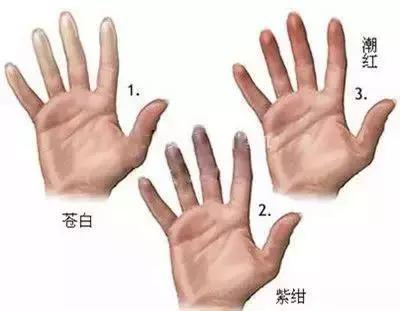 哪些症状要看风湿免疫科,什么症状要看风湿免疫科