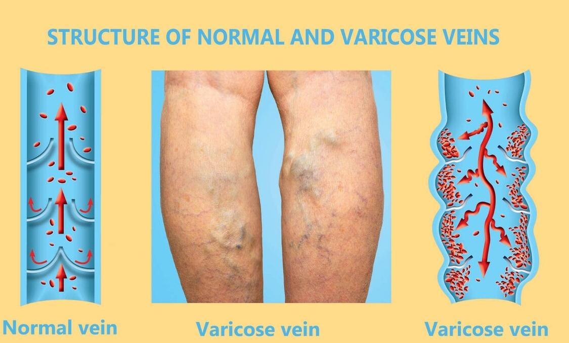 单侧小腿静脉血栓严重吗女性,左下肢深静脉血栓是什么症状