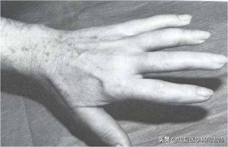 脑卒中后偏瘫患者常见并发症：肩手综合征的康复治疗