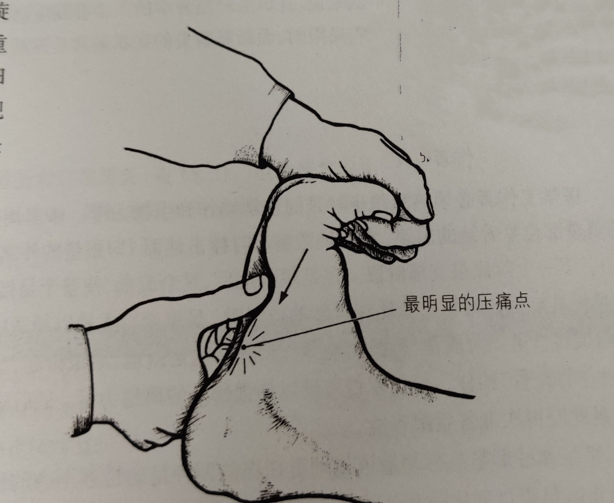 足跟康复指导视频,足跟痛康复理疗