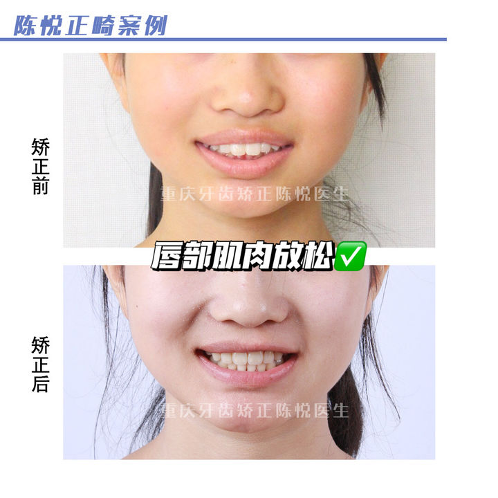 嘴凸深覆合可以自己矫正吗,上海牙齿龅牙矫正