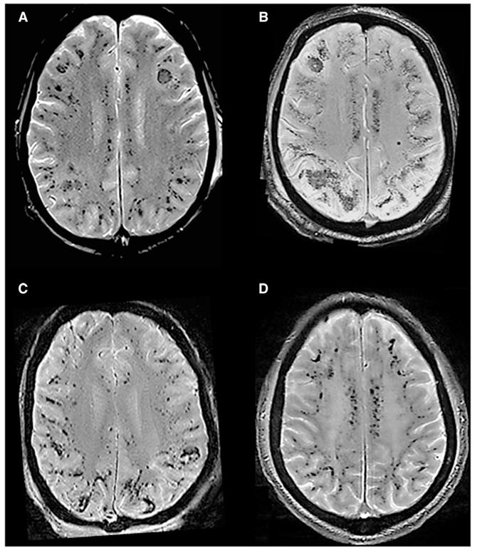 头疼做磁共振脑小血管有点出血,核磁共振说脑血管出血