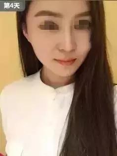 瘦脸针的5个常见问题,瘦脸针其实副作用挺大的