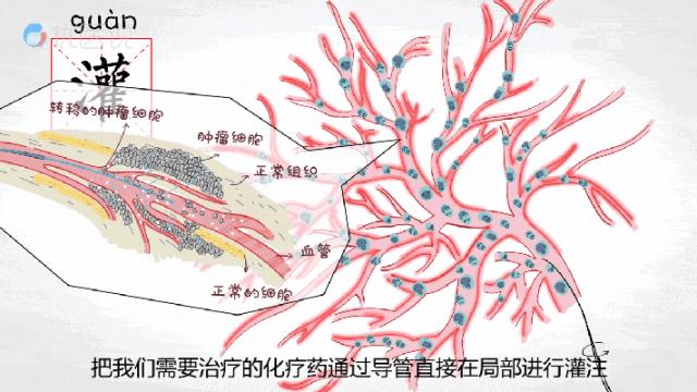 颅内肿瘤微创介入的条件,广东哪家医院肿瘤微创介入治疗好