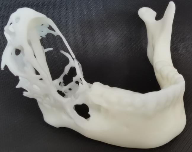 口腔龋齿发病原因讲座,口腔医生科普龋齿处理