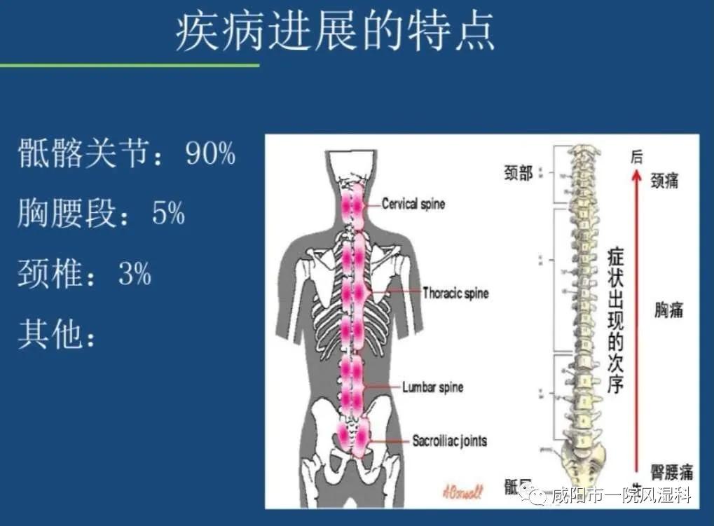 强直性脊柱炎号称不死的癌症,咸阳市强直性脊柱炎定点医院