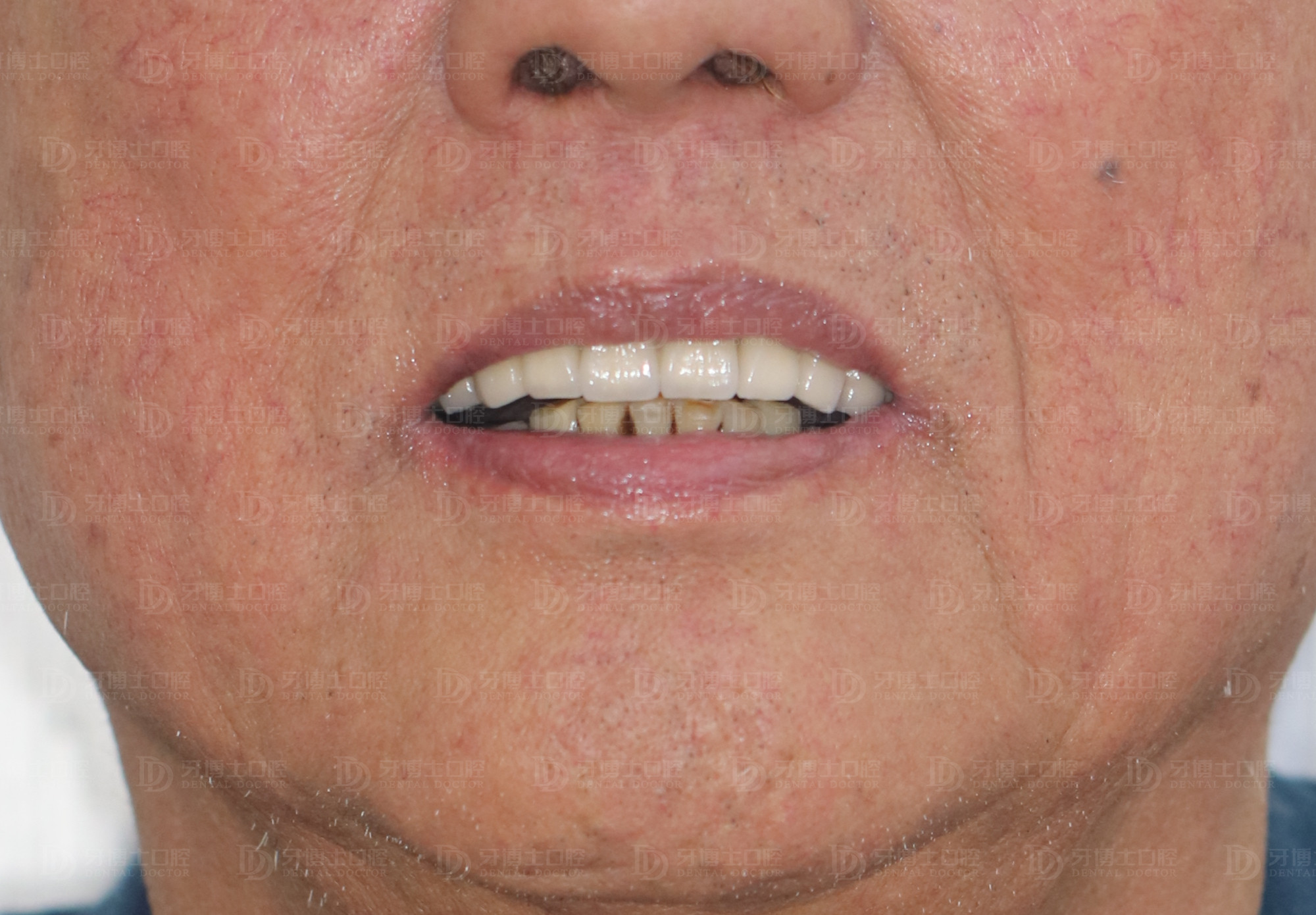 有牙根的缺牙不补,缺牙不补上面的牙掉下来