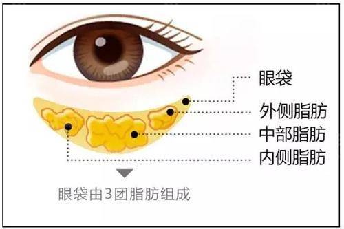 眼袋过大是什么原因怎么办,请问眼袋大是什么引起的怎么治疗