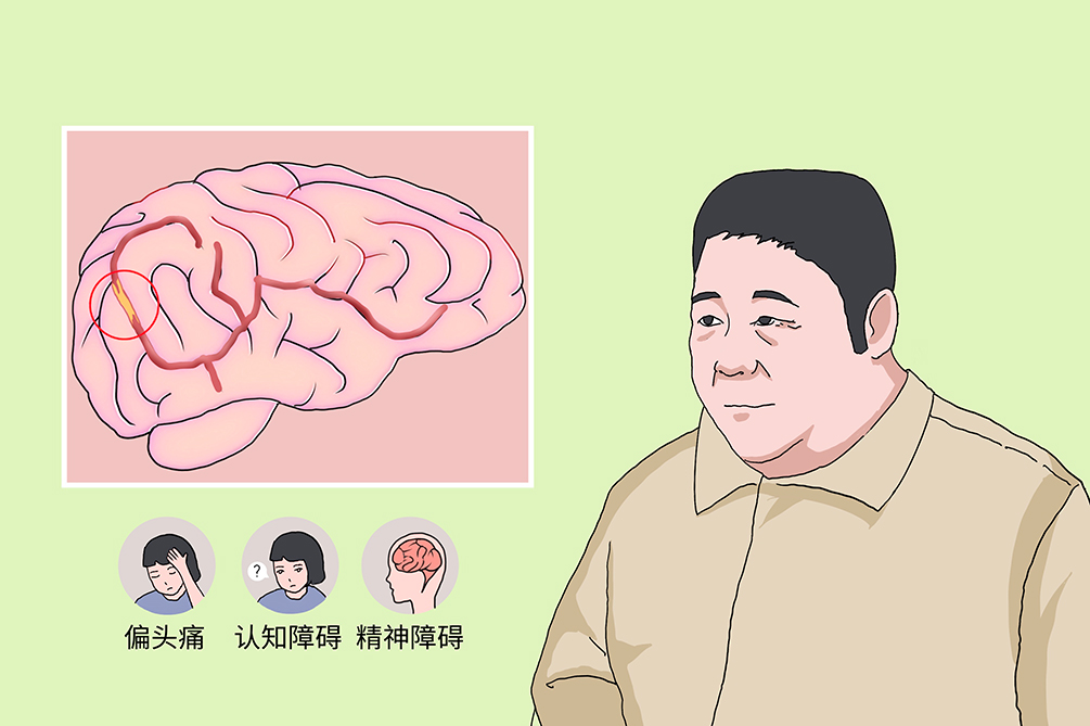 遗传性脑梗死真的遗传吗,脑血管病变引起的痴呆遗传