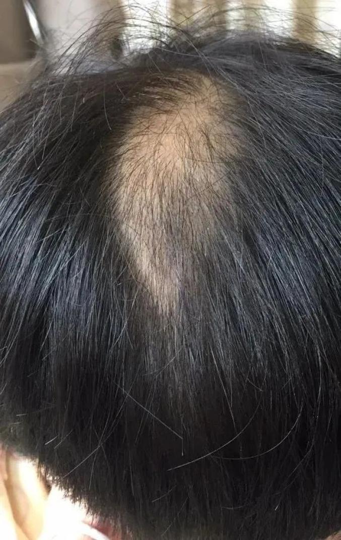 被家长逼着上辅导班,上海两岁男童学习压力大斑秃