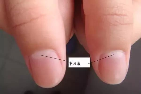 指甲月牙少有白点,指甲月牙消失有竖纹是怎么回事