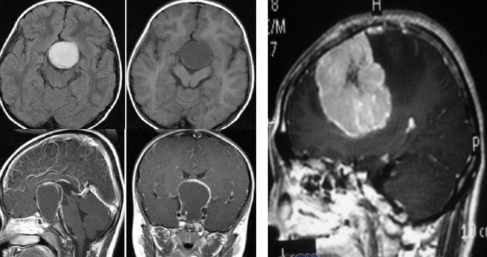 儿童反复呕吐精神正常,儿童频繁呕吐有血丝