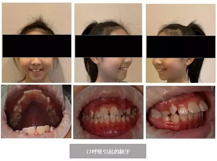 口呼吸变丑矫正需要多久,长期口呼吸会嘴凸吗