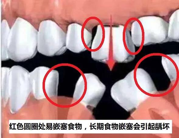 蛀牙不补能不能戴牙套,蛀牙不补认真刷牙可以防止变严重吗