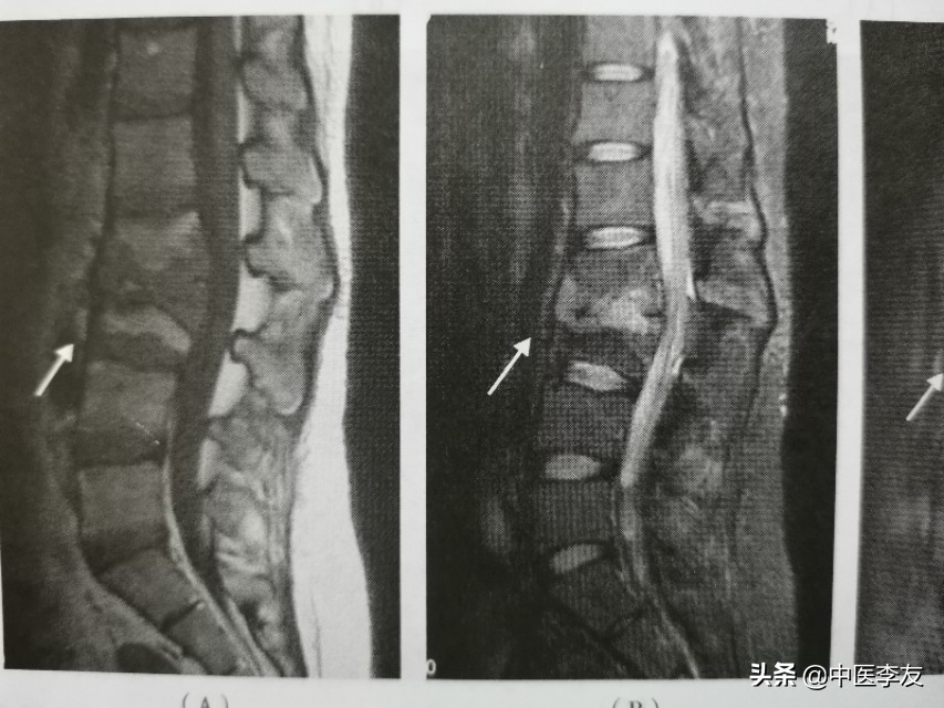 腰椎骨结核治愈后出现腰疼,脊柱结核腰痛怎么治