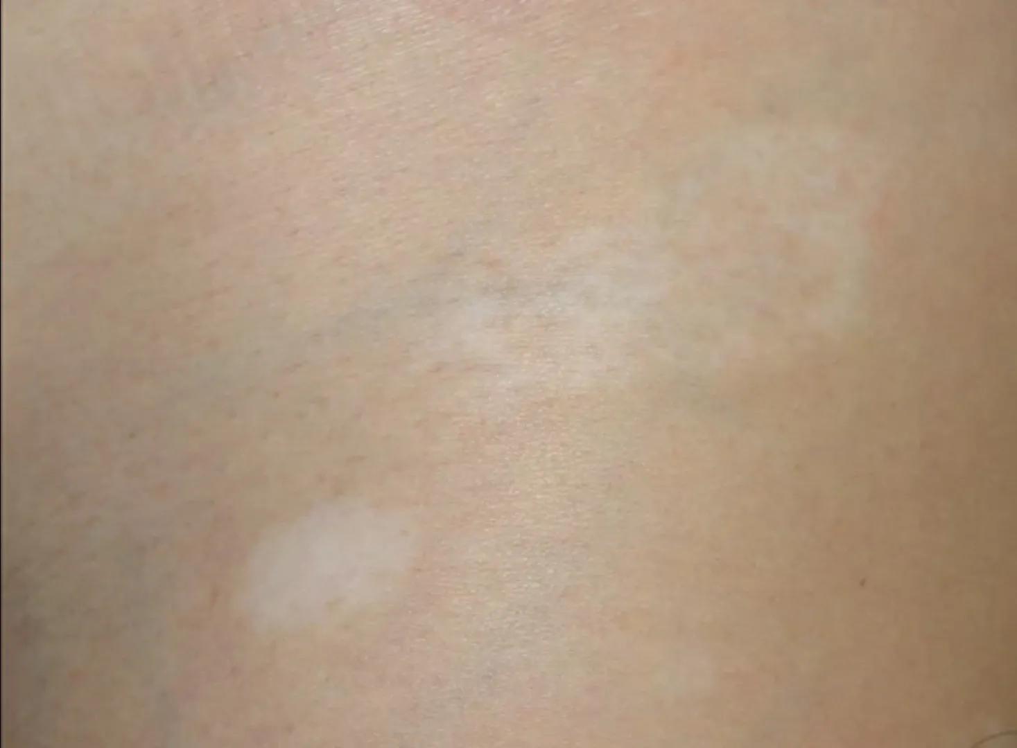 治白癜风外用软膏,白癜风外用效果好