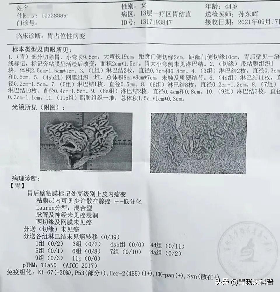 拔鱼刺胃癌早期,取一个鱼刺去了一趟医院