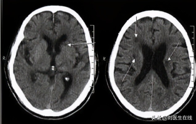 55岁王阿姨长期吃阿司匹林，却脑梗复发，医生心脏听诊找到了原因