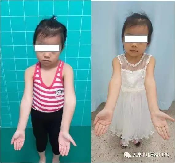 儿童胳膊肘朝外拐怎么办,小孩胳膊肘往外拐为什么会黑