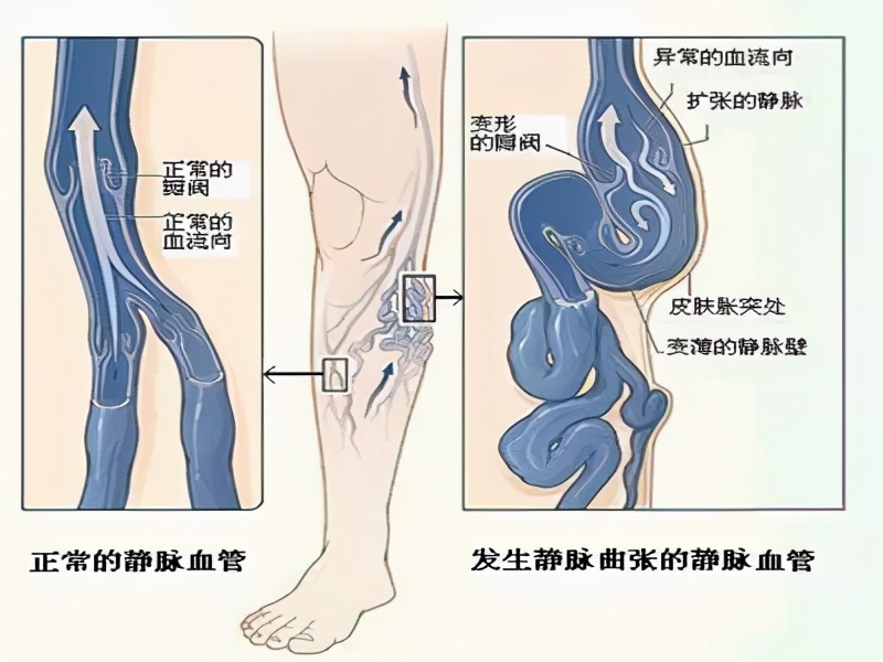 腿上血管像蜘蛛网一样怎么回事,腿上血管像蚯蚓