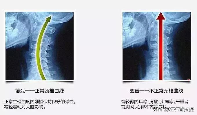 颈椎病疼痛缓解方法,颈椎病酸痛难忍怎么办