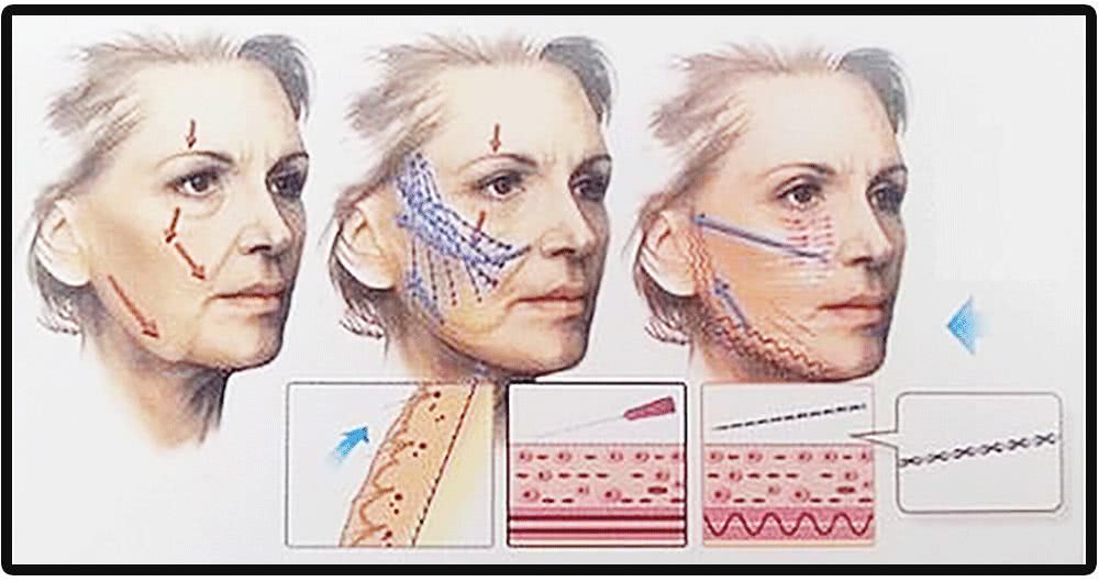 张雨绮说做超声刀就像在烤肉？我去体验了一把……