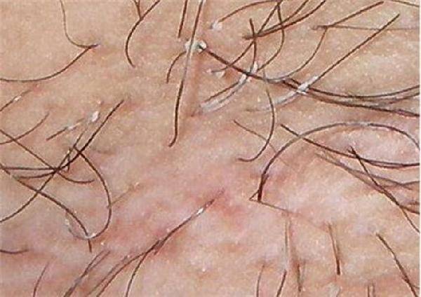 毛发稀少毛躁,毛发稀少一定是雄性激素不够吗