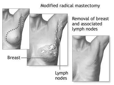 乳腺癌乳房破溃治疗步骤,乳房里肿块怎么动手术