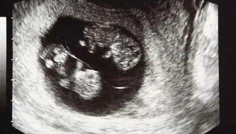 怀孕30多周胎停有什么症状,有过停胎史怀孕32天需要去医院吗