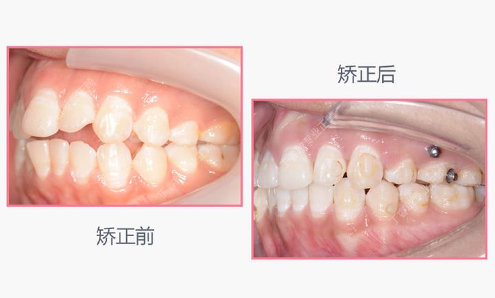 单颗牙隐形矫正,郑州隐形矫正牙齿哪家便宜