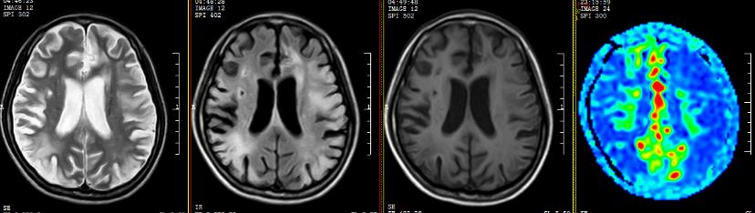 医生给脑血管搭桥,外科医生给年轻女孩做手术