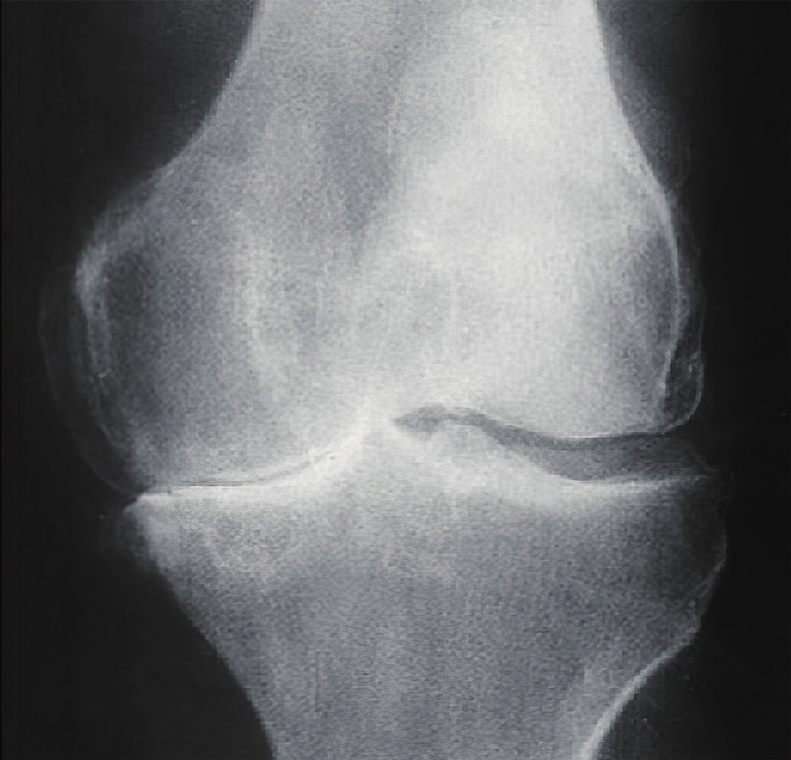 膝关节骨关节炎怎样手术能治好,膝关节镜能治好关节炎吗